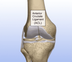 ACL Tears Treatment and Surgery - iOrtho Staten Island and NYC
