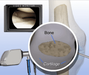 image of knee cartilage