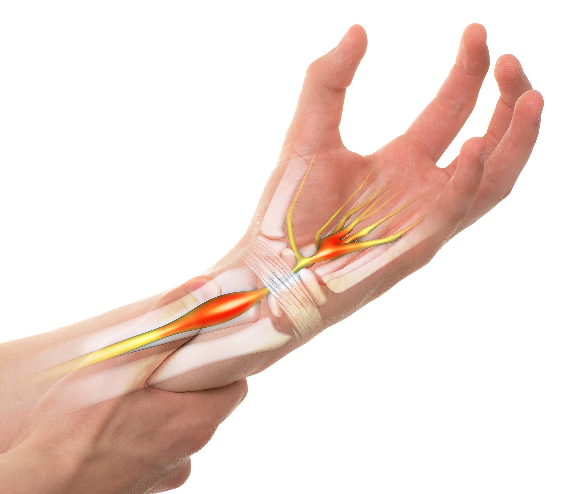 Carpal Tunnel Release iOrtho
