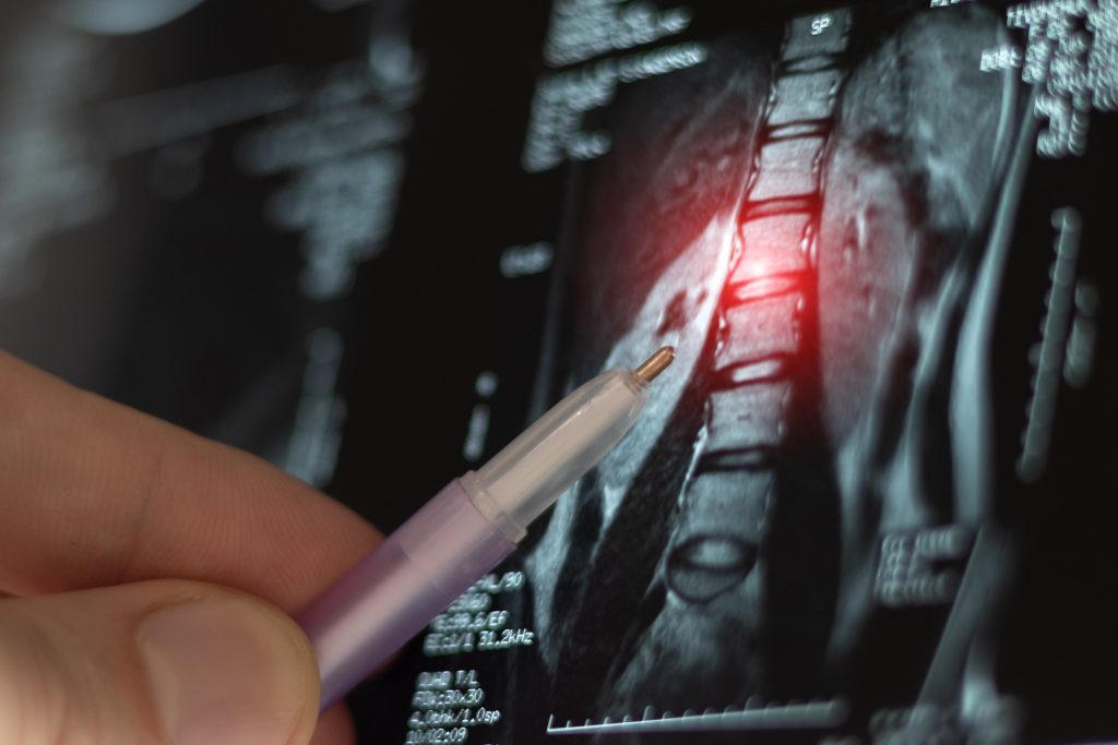 Minimally Invasive Spine Surgery